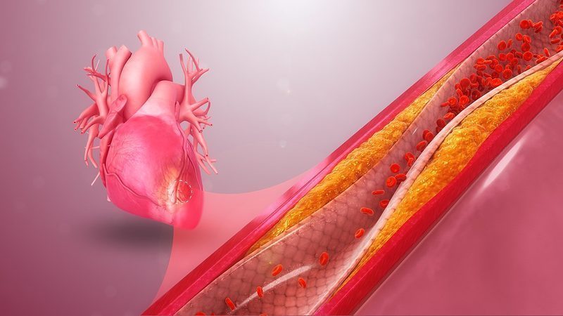 Ilustración de arteria con placa aterosclerótica